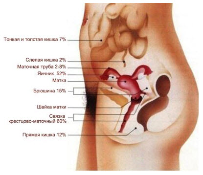 ендометріоз