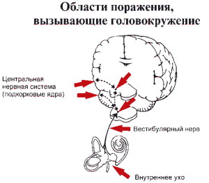 У голові паморочиться при захворюваннях головного мозку і органів голови