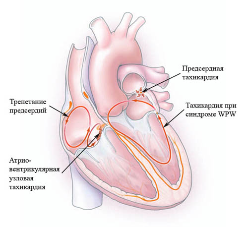 Всі причини тахікардії - види